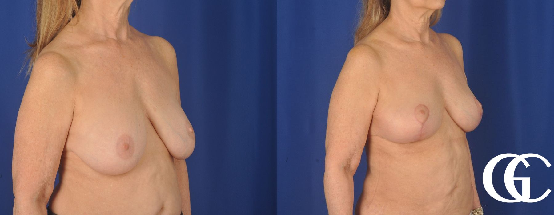 Complex Breast Augmentation - Thumbnail 2