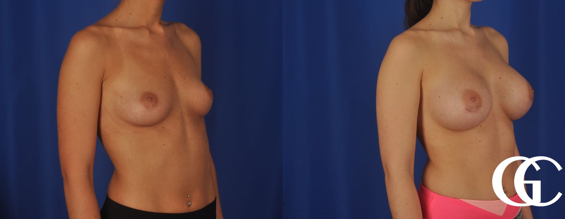 Complex Breast Augmentation - Thumbnail 4