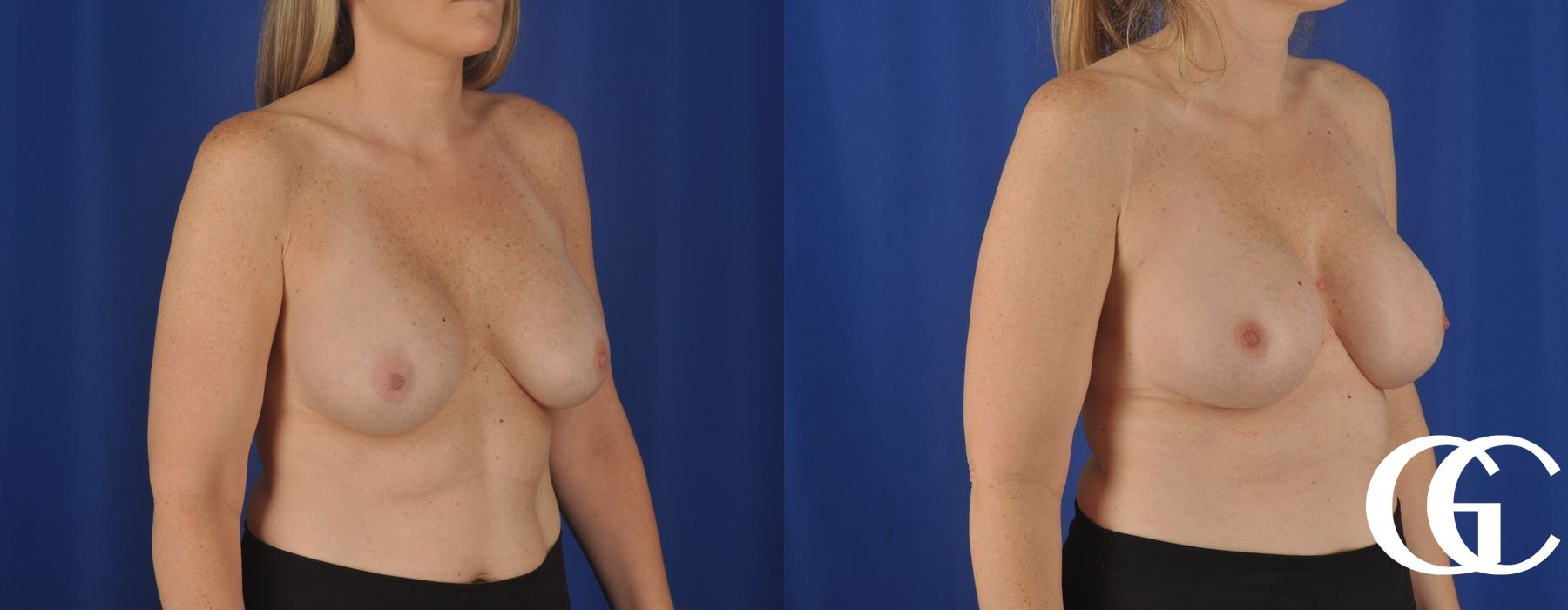 Complex Breast Augmentation - Case 7368