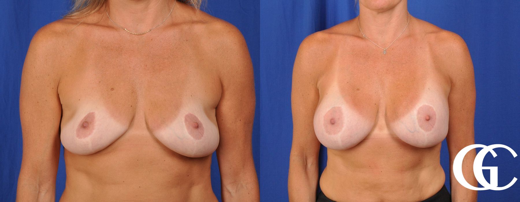 Complex Breast Augmentation - Thumbnail 2