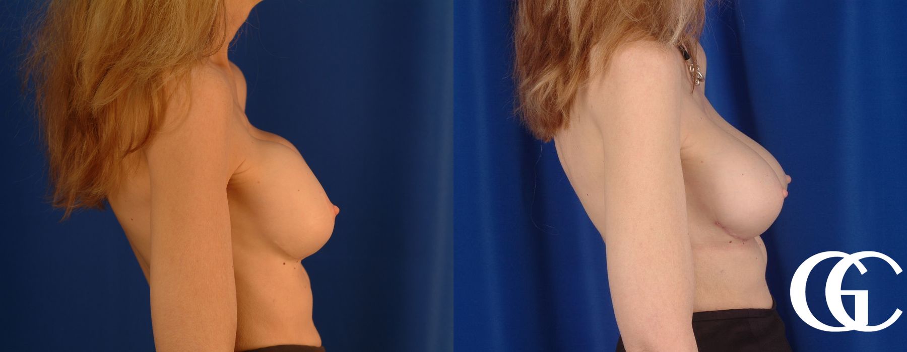 Complex Breast Augmentation - Thumbnail 4