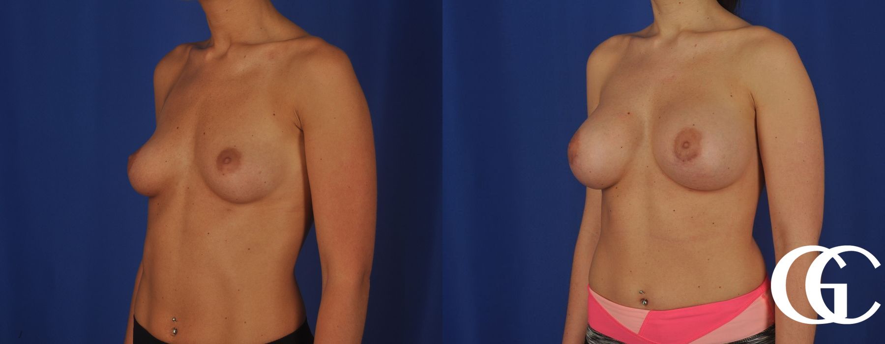 Complex Breast Augmentation - Thumbnail 2