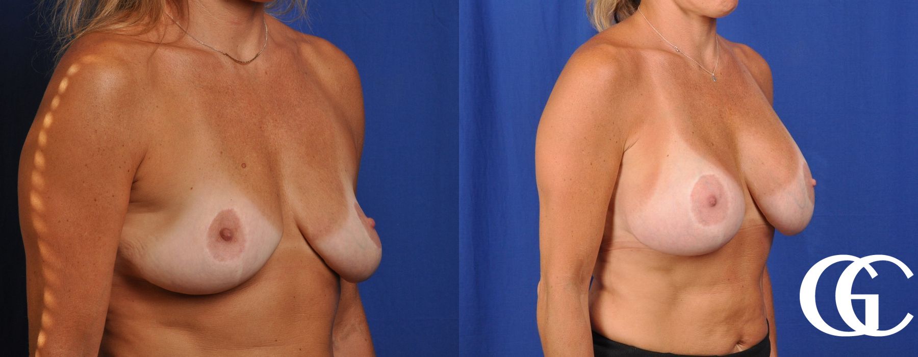 Complex Breast Augmentation - Case 7350