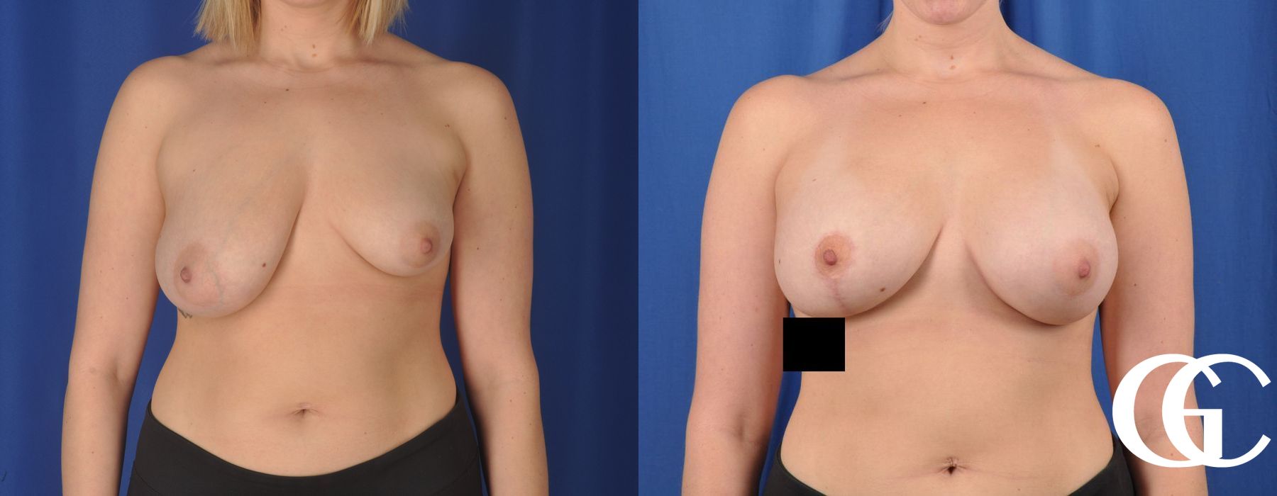 Complex Breast Augmentation - Thumbnail 2