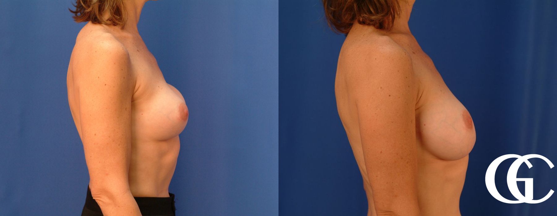 Complex Breast Augmentation - Case 7358