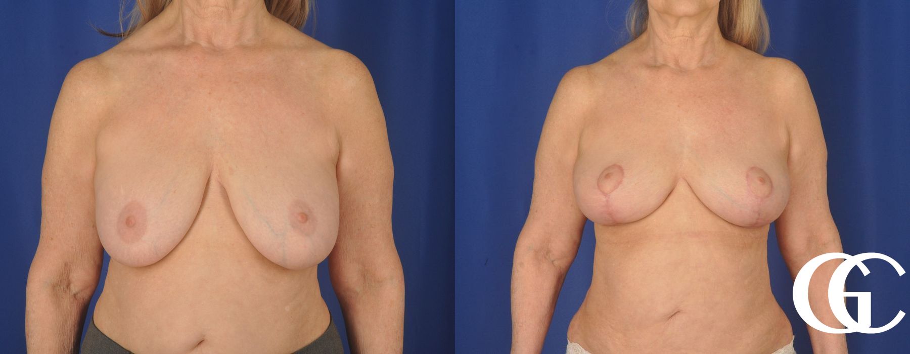Complex Breast Augmentation - Case 7342