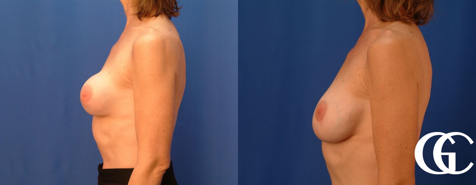 Complex Breast Augmentation - Thumbnail 4