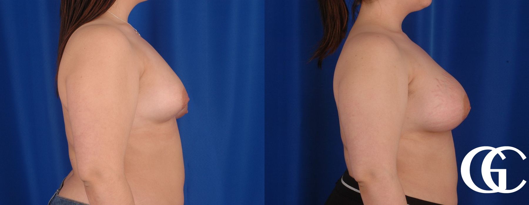 Complex Breast Augmentation - Thumbnail 3