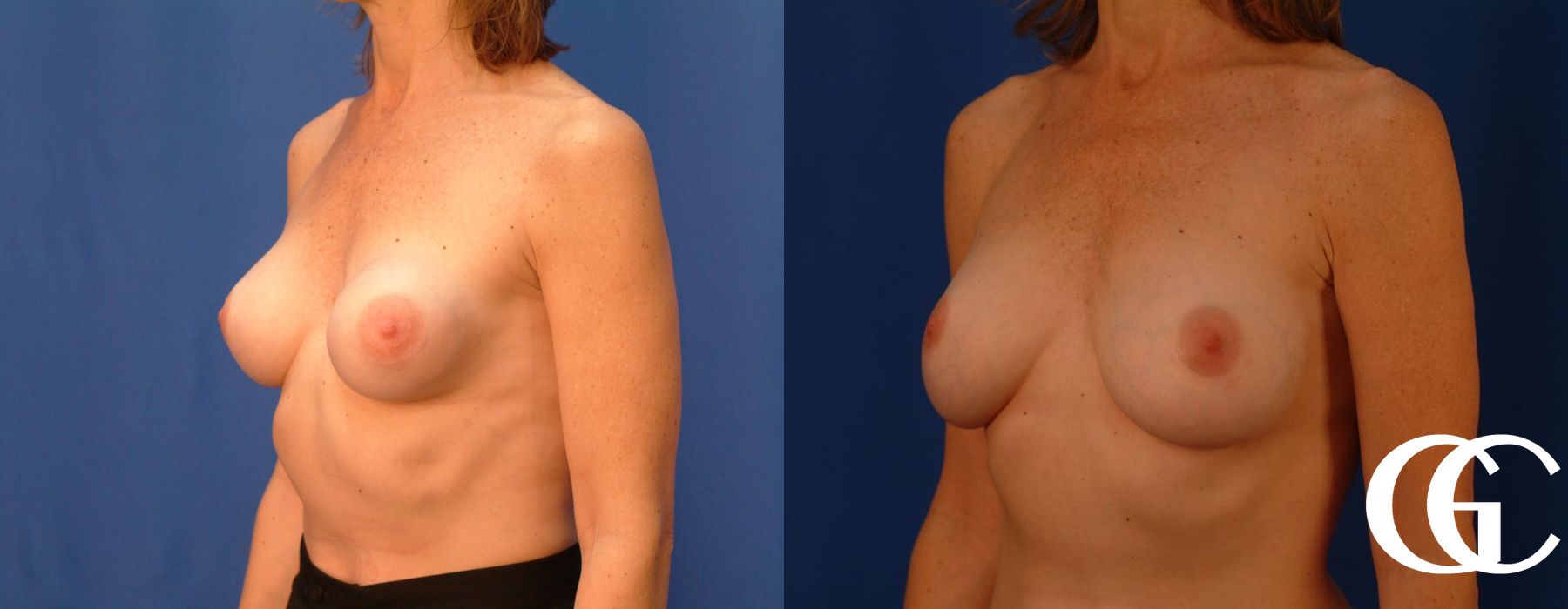 Complex Breast Augmentation - Thumbnail 3
