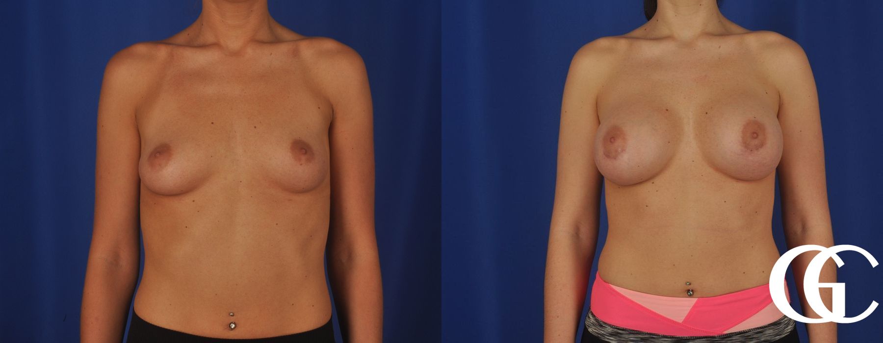 Complex Breast Augmentation - Thumbnail 3