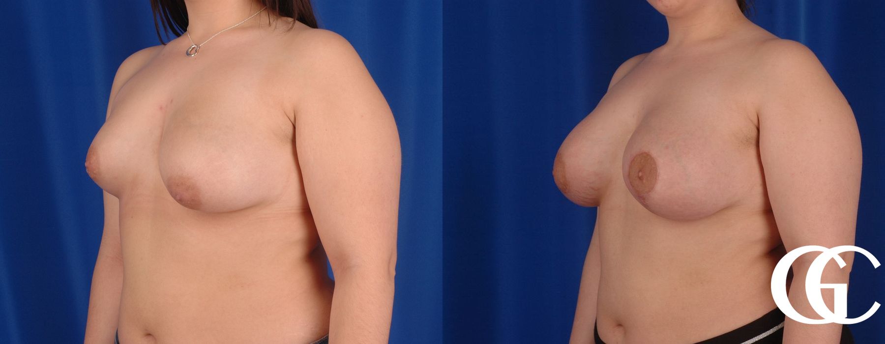 Complex Breast Augmentation - Thumbnail 5