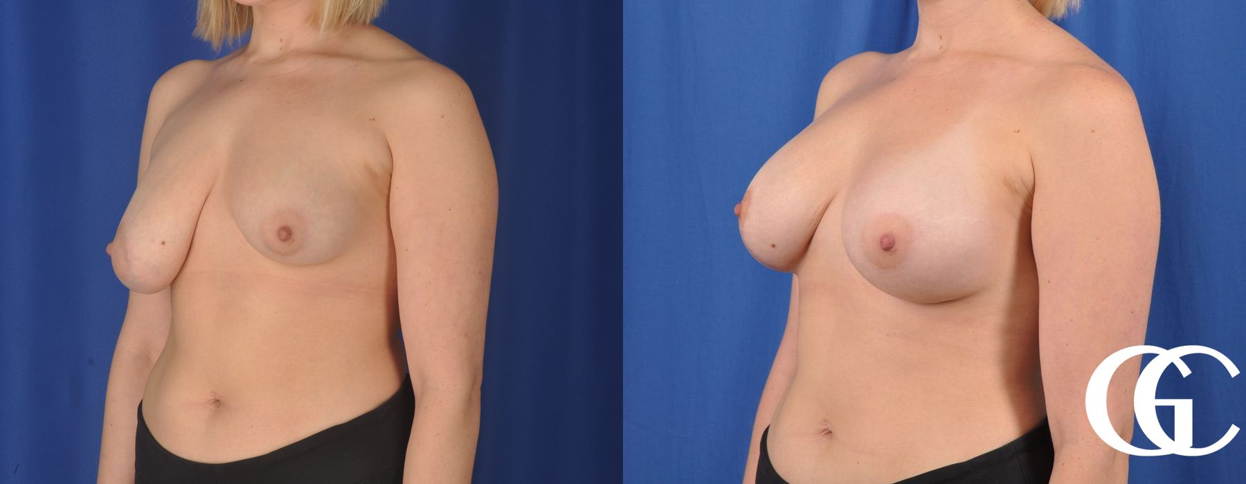 Complex Breast Augmentation - Thumbnail 4