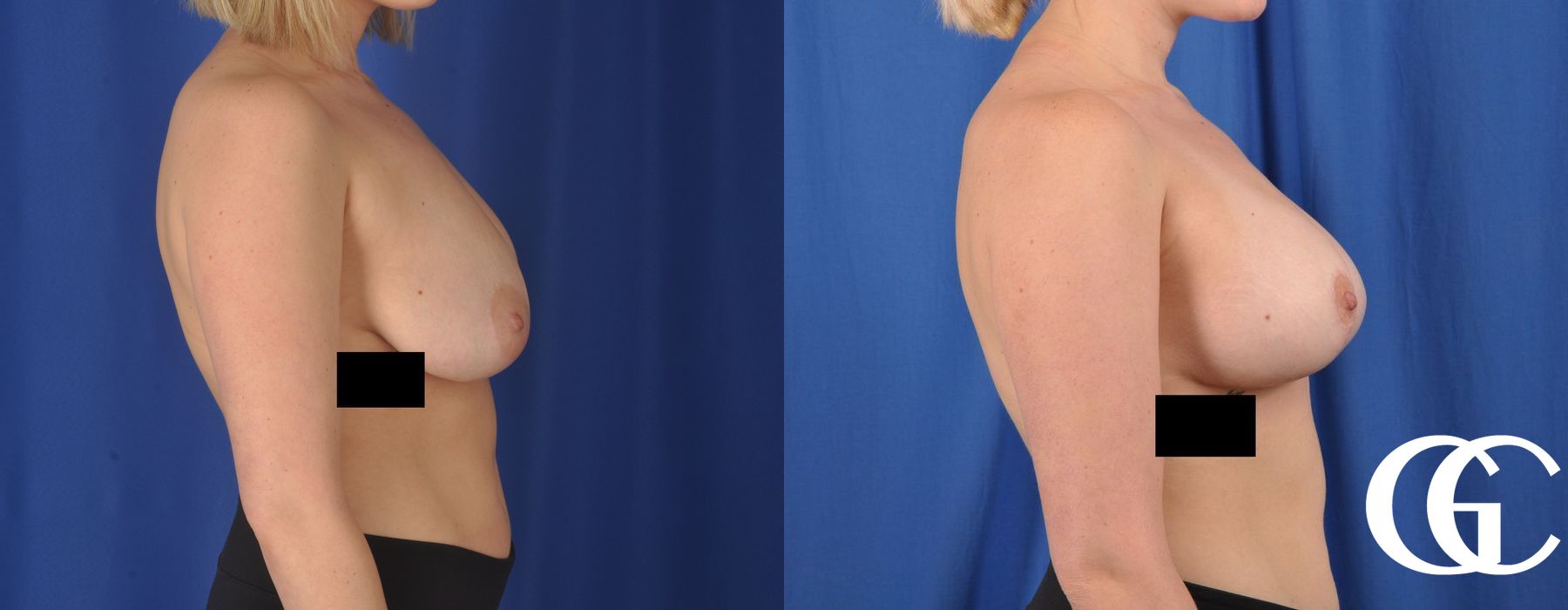 Complex Breast Augmentation - Thumbnail 3