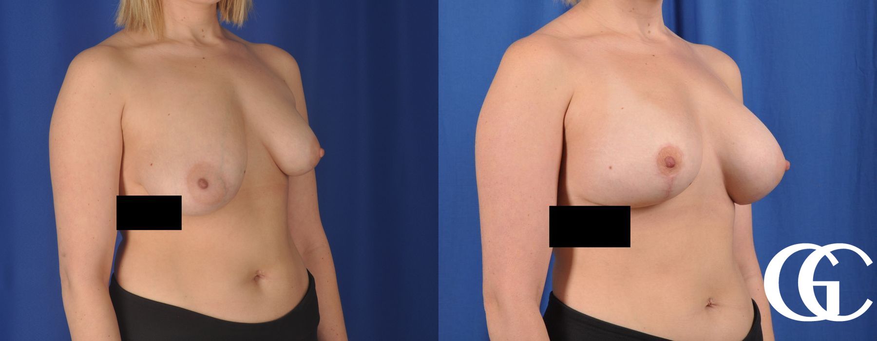 Complex Breast Augmentation - Case 7373