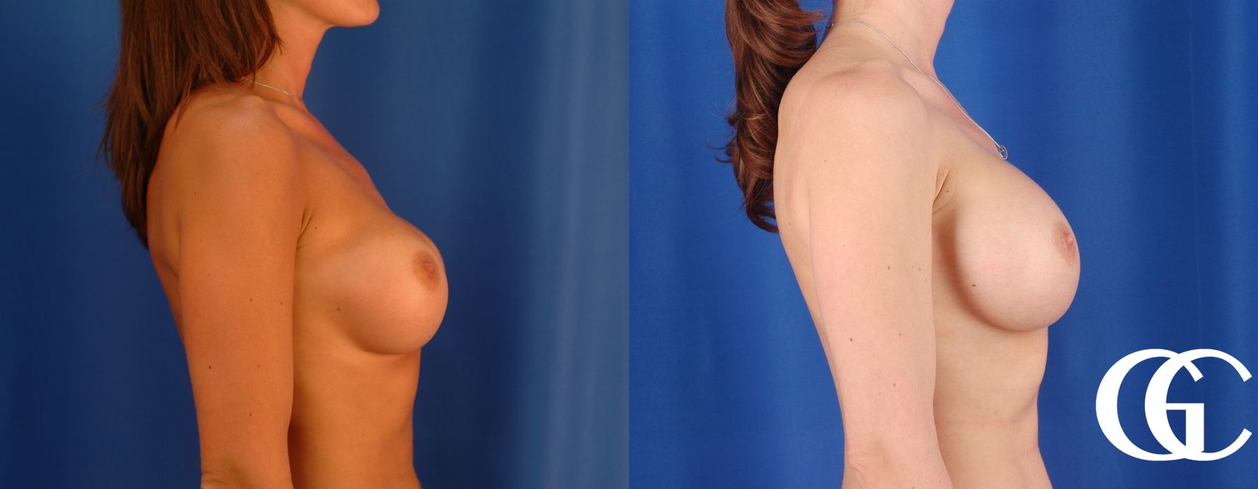 Complex Breast Augmentation - Case 7361