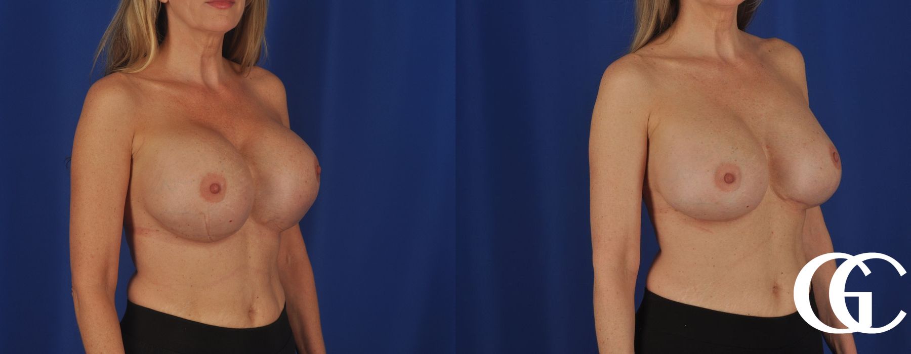 Complex Breast Augmentation - Thumbnail 3