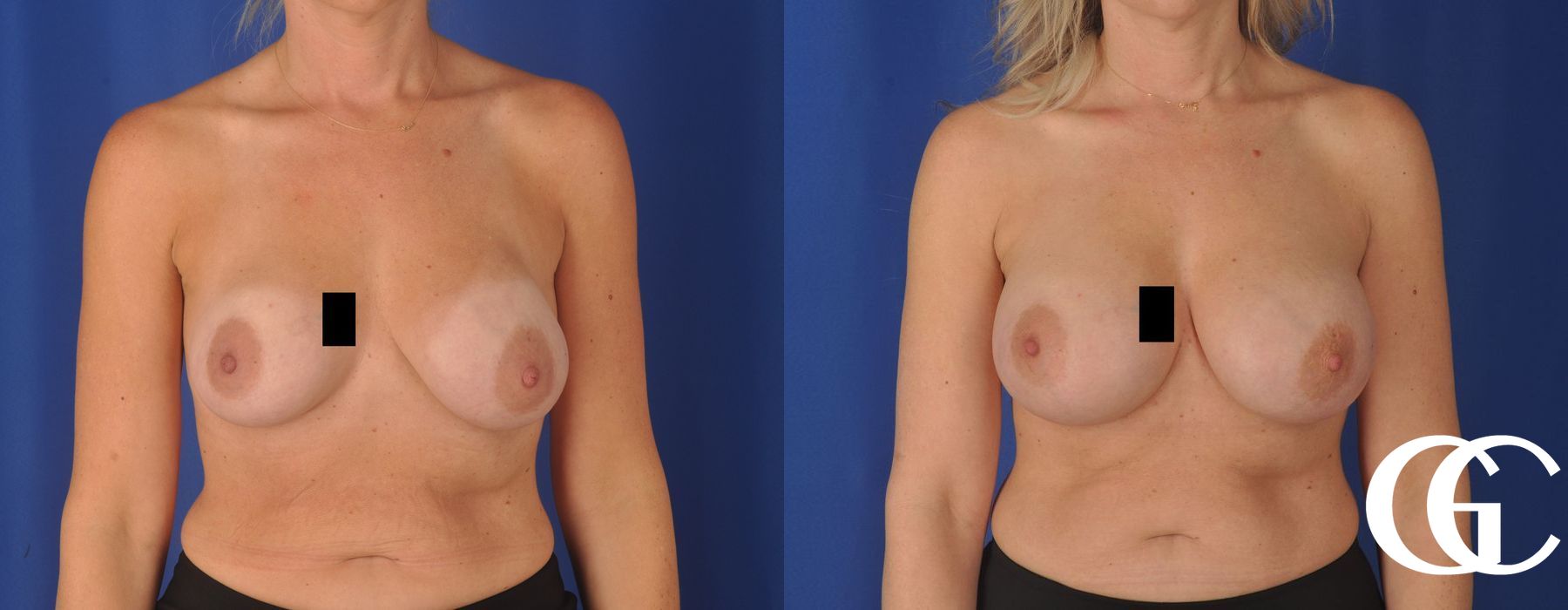 Complex Breast Augmentation - Case 7370