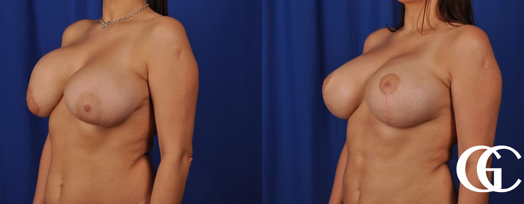 Complex Breast Augmentation - Thumbnail 5