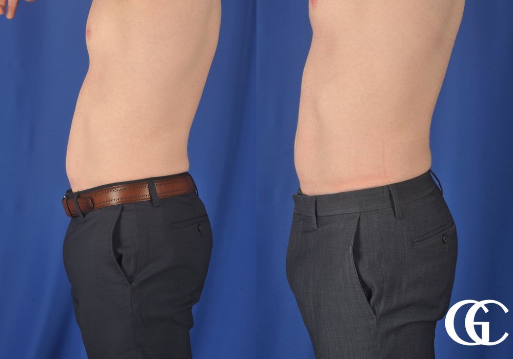 EMSCULPT® - Thumbnail 3