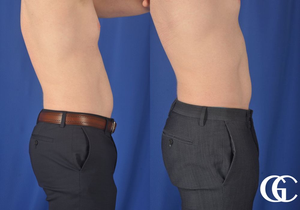 EMSCULPT® - Thumbnail 2