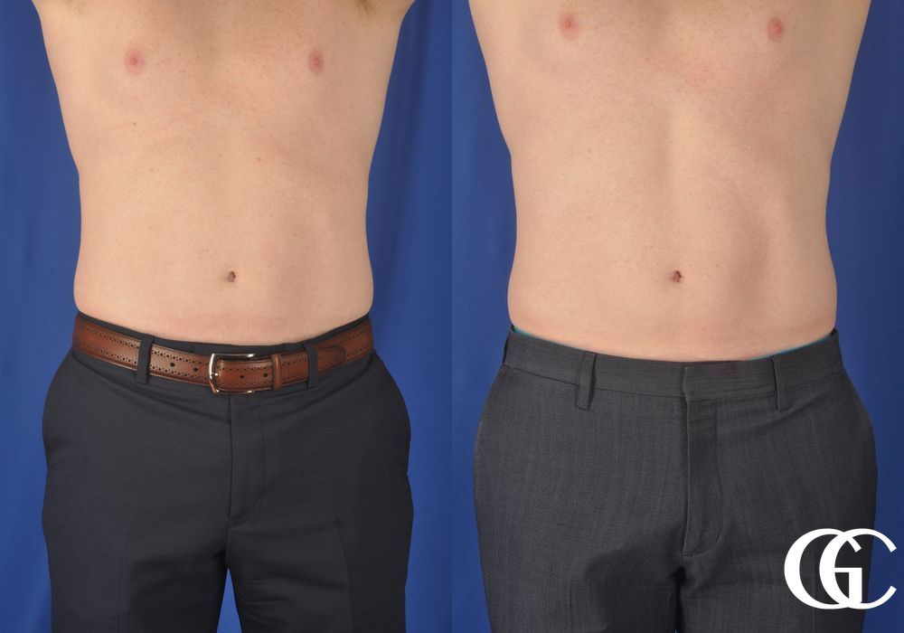 EMSCULPT® - Case 7442