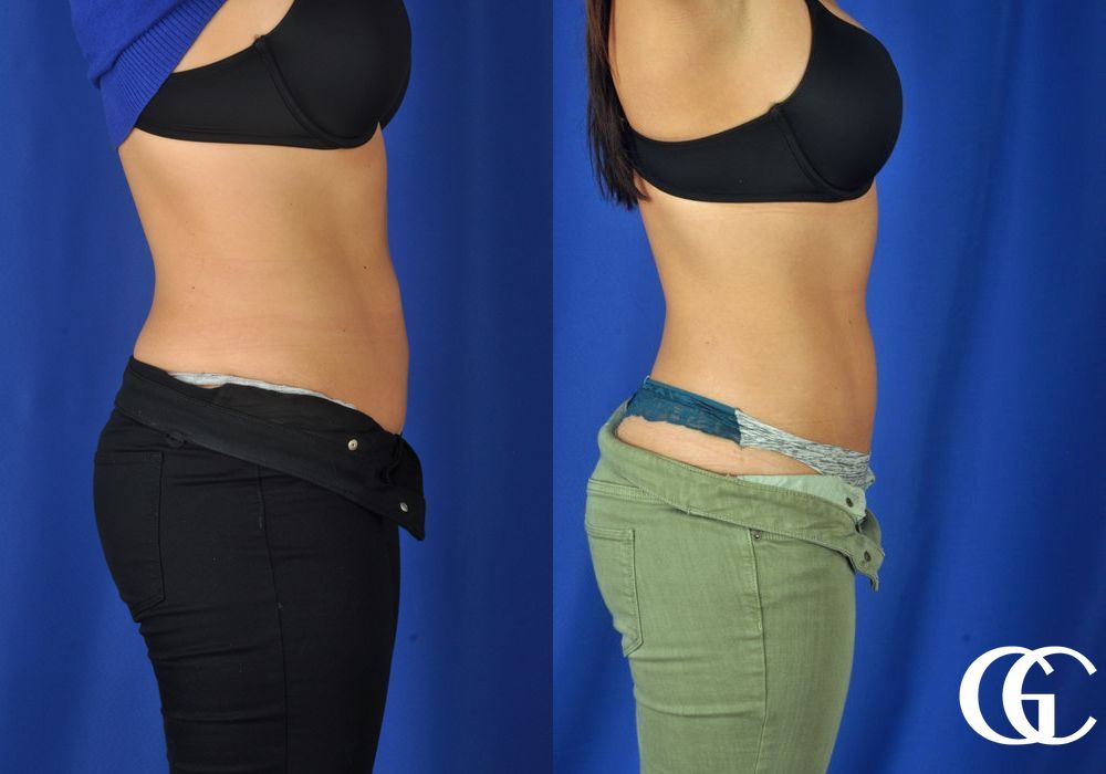 EMSCULPT® - Thumbnail 2