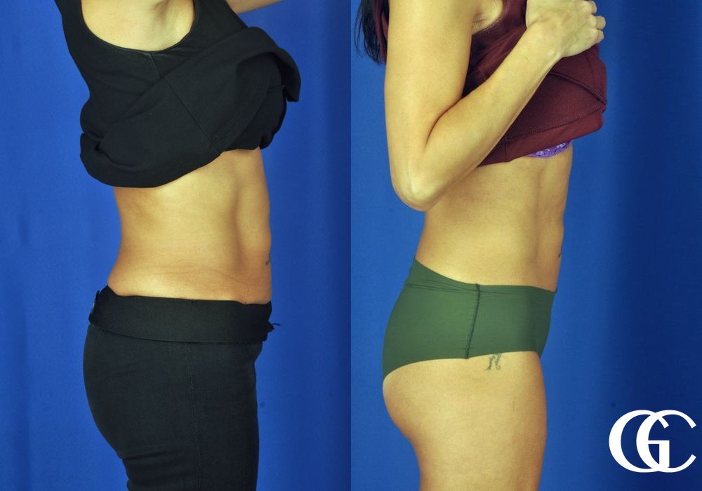 EMSCULPT® - Case 7440