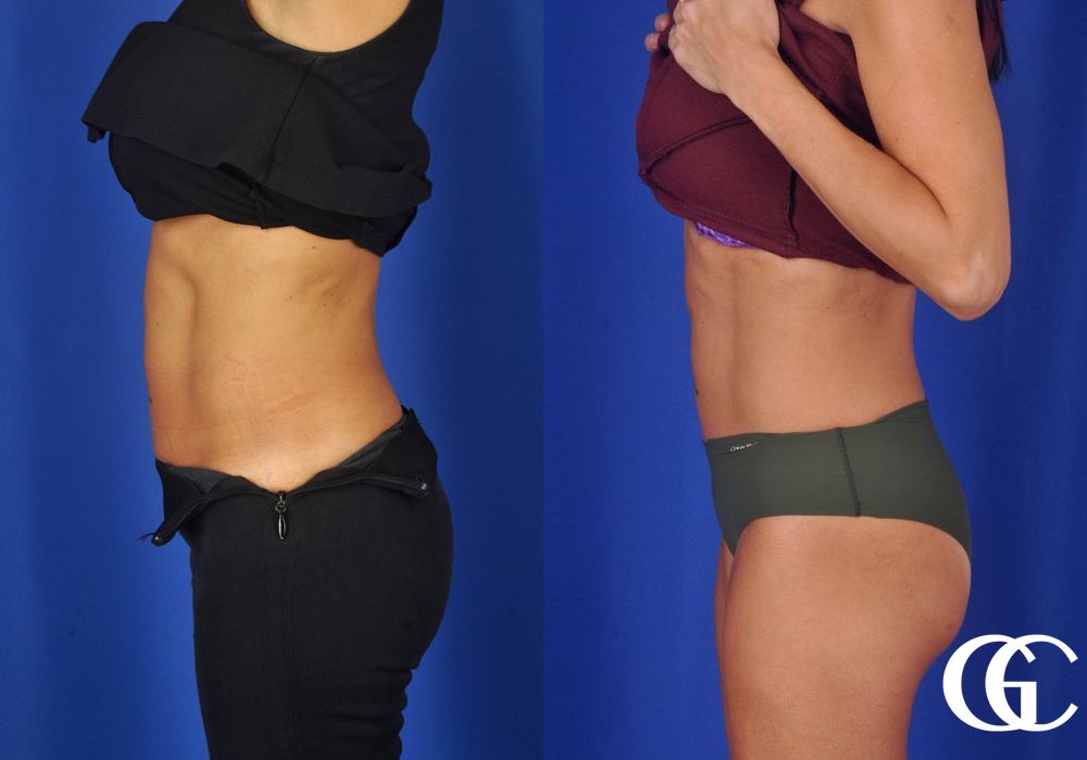 EMSCULPT® - Thumbnail 2