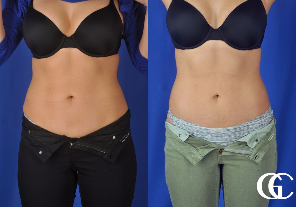 EMSCULPT® - Case 7441