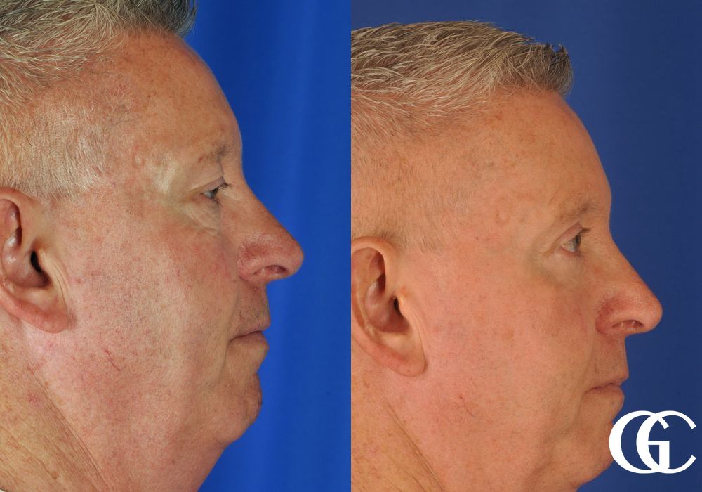 Eyelid Lift - Thumbnail 5