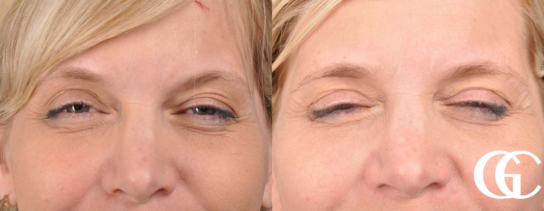 Eyelid Lift - Thumbnail 3