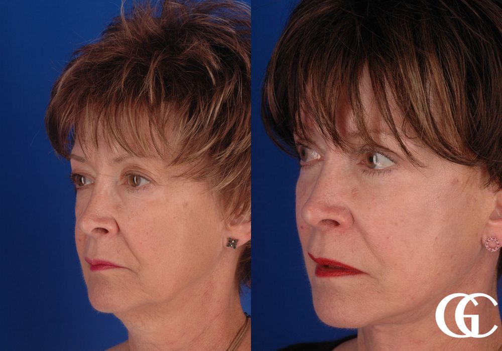 Eyelid Lift - Thumbnail 5