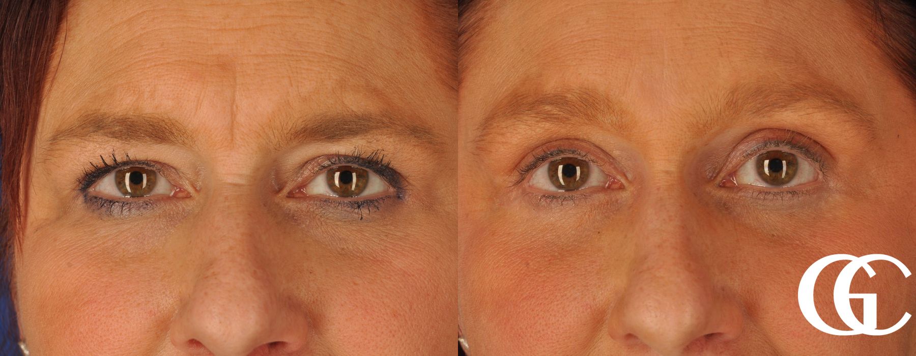 Eyelid Lift - Thumbnail 2