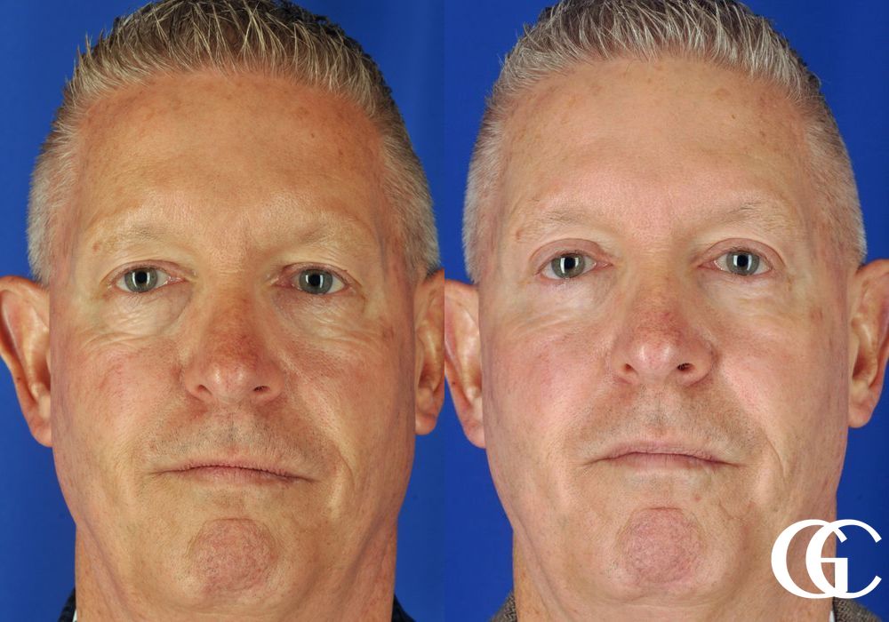 Eyelid Lift - Thumbnail 3