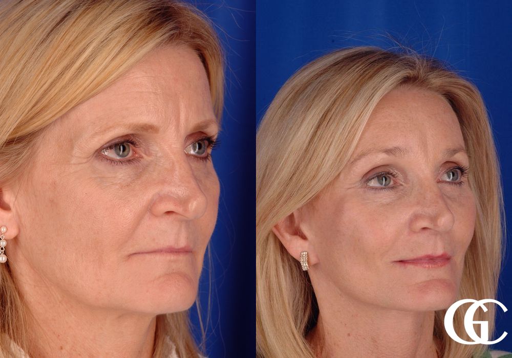 Eyelid Lift - Thumbnail 3