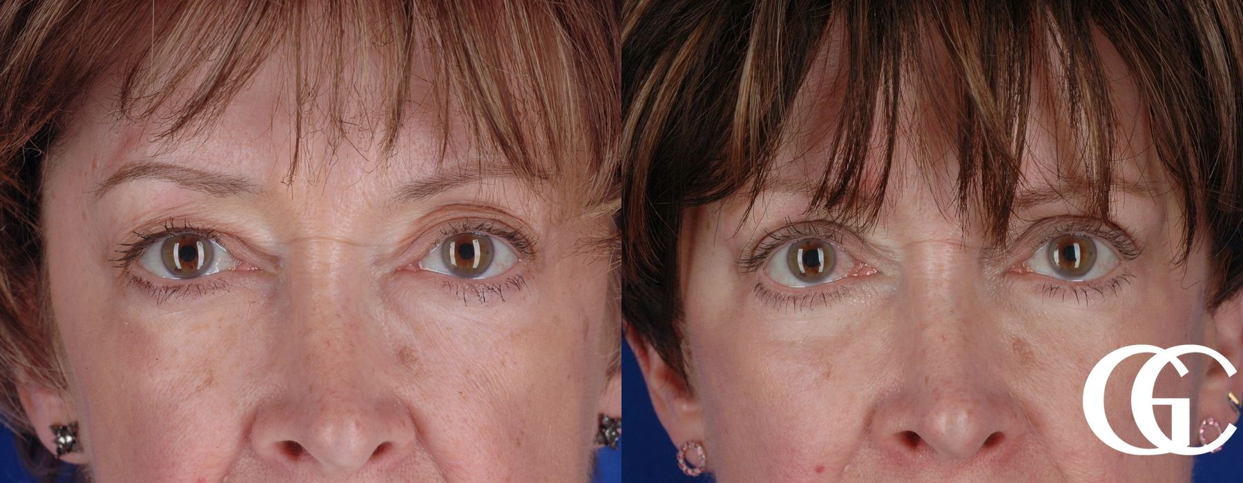 Eyelid Lift - Case 7398