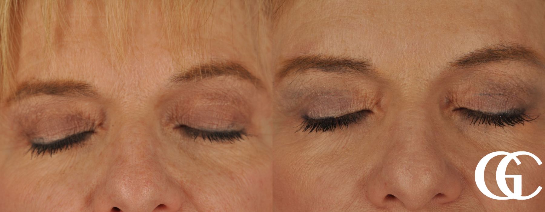 Eyelid Lift - Thumbnail 2