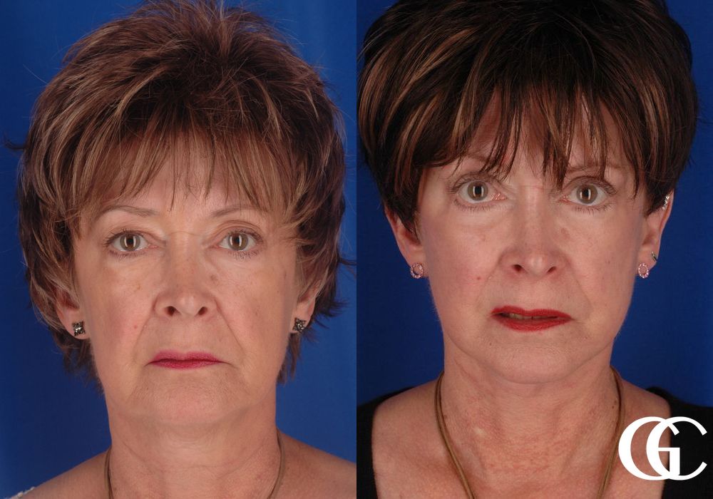 Eyelid Lift - Thumbnail 3