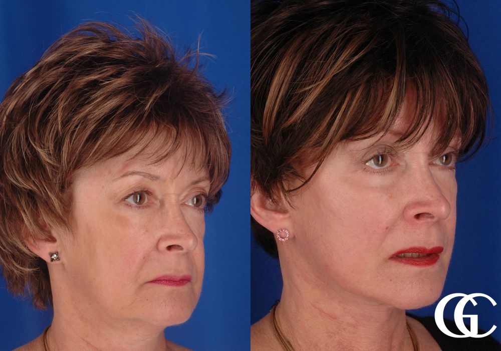 Eyelid Lift - Thumbnail 4