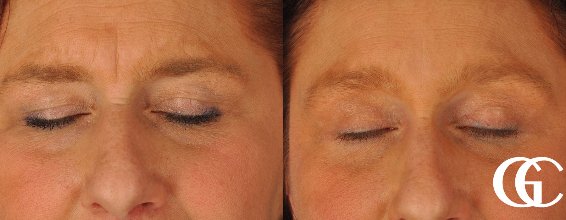 Eyelid Lift - Thumbnail 3