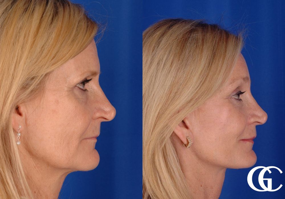 Eyelid Lift - Case 7395