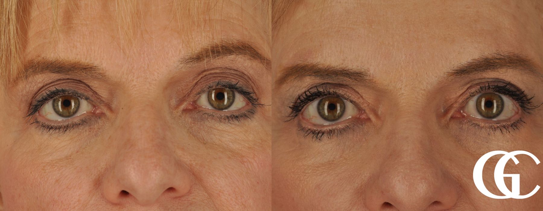 Eyelid Lift - Case 7400