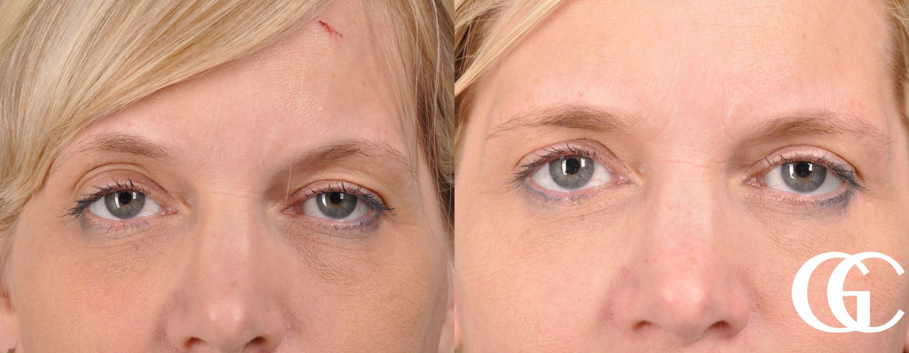 Eyelid Lift - Case 7404