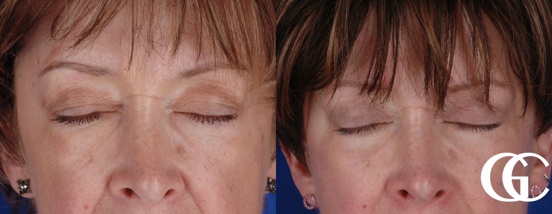 Eyelid Lift - Thumbnail 2