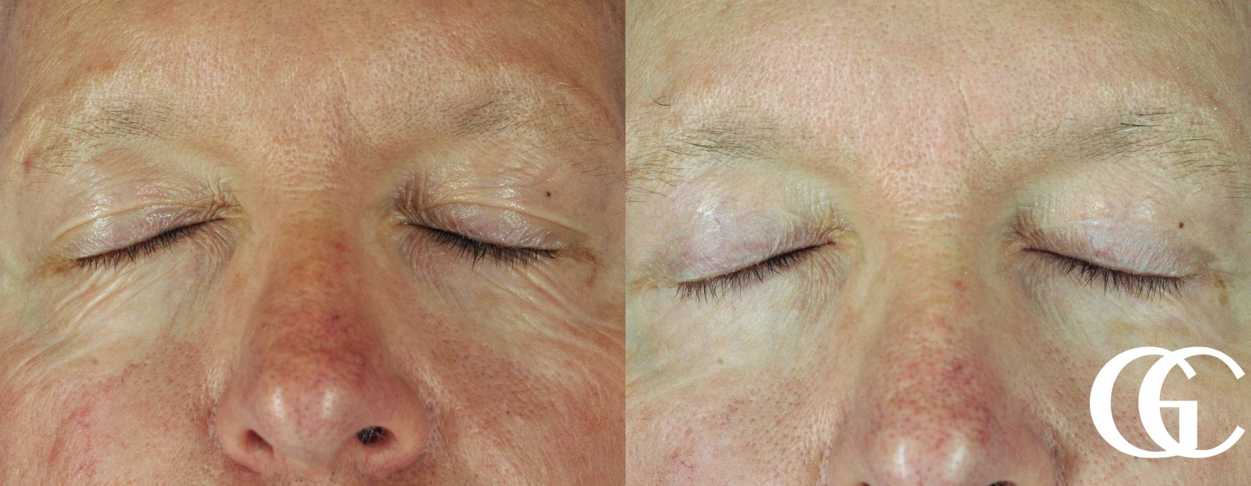 Eyelid Lift - Case 7403