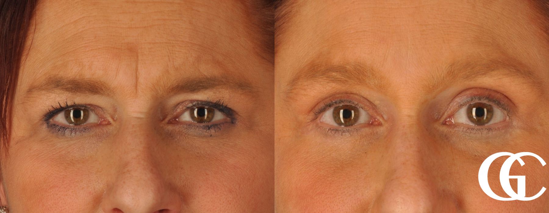 Eyelid Lift - Case 7401