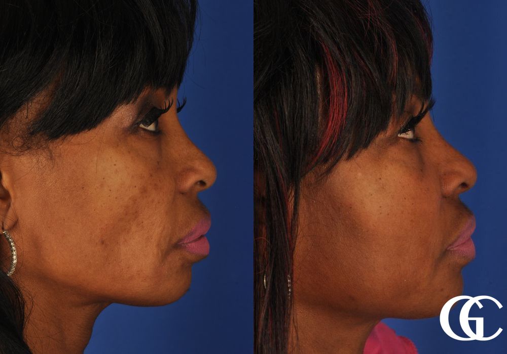 Facelift - Thumbnail 3