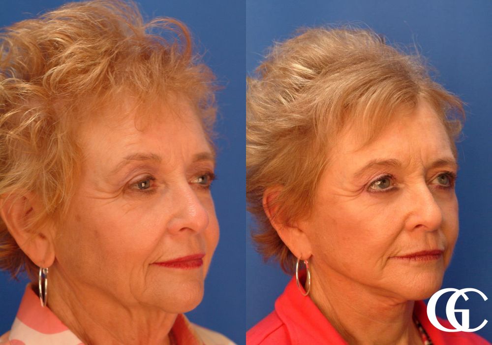 Facelift - Thumbnail 4