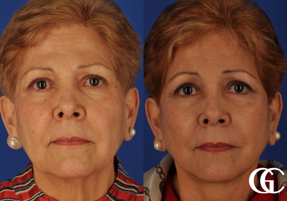 Facelift - Case 7415