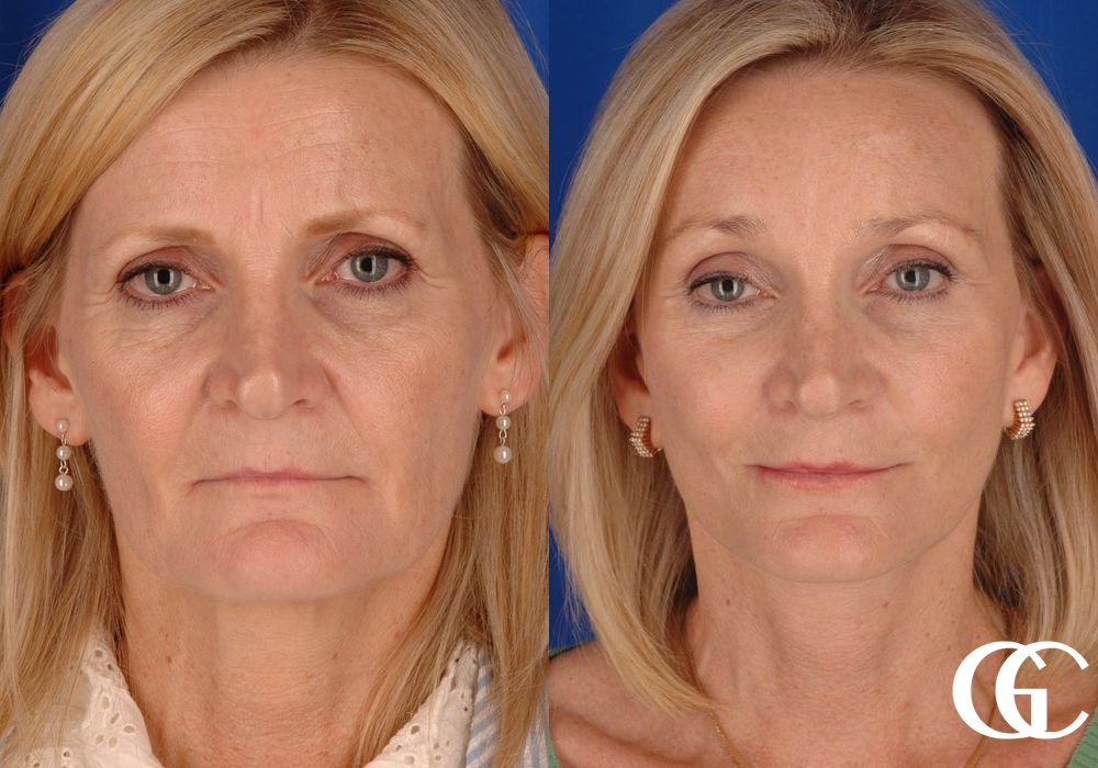 Facelift - Case 7408